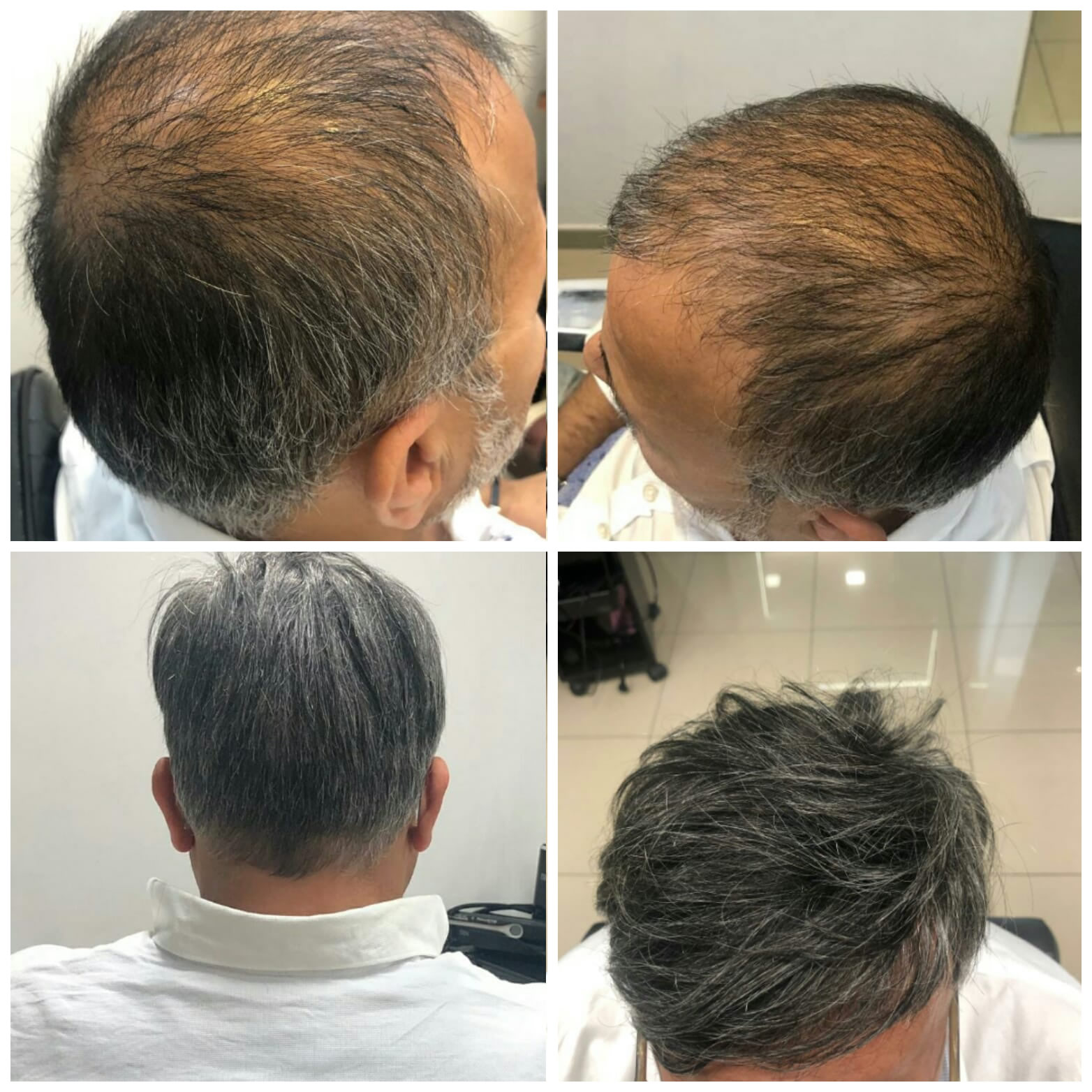 extension alopecia androgenetica